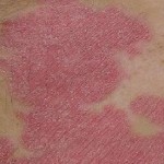 Bệnh vảy da và những điều bạn nên biết