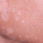Triệu chứng của bệnh nấm da