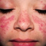 Triệu chứng bệnh lupus ban đỏ hệ thống