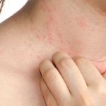 Biểu hiện của bệnh eczema