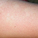 Bệnh viêm nang lông và những câu hỏi thường gặp