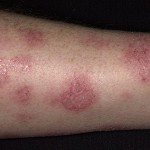 Phương pháp điều trị eczema