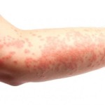 Tìm hiểu về bệnh eczema