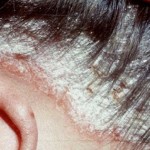 Vảy nến da đầu – bệnh không của riêng quốc gia nào