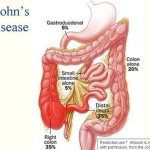 Tổng quan bệnh Crohn