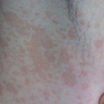 Bệnh nấm da có chữa được không?