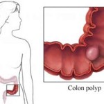Cắt polyp đại tràng qua nội soi