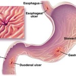 Triệu chứng của viêm loét dạ dày – tá tràng