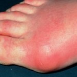 Triệu chứng của bệnh gout