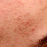 Cách nào giải quyết tình trạng da mặt nổi mụn sần sùi?