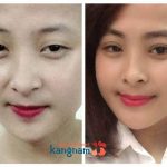 4 xu thế thẩm mỹ mắt Hàn Quốc “gây bão” 2016